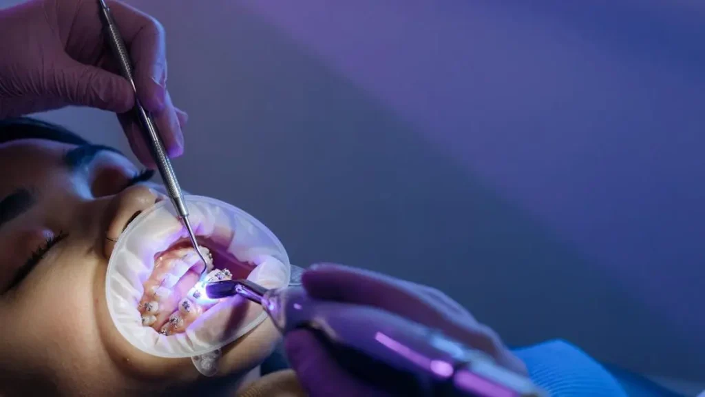 9 Reasons to Choose Clear Aligners vs. Brackets