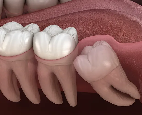 wisdom tooth extraction near you