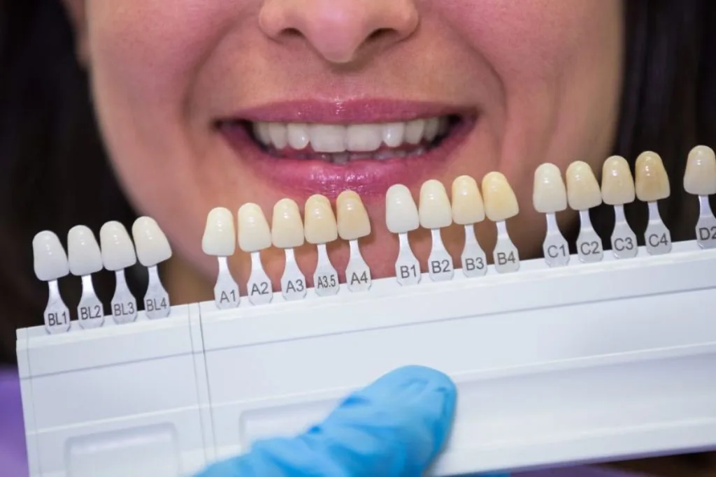 porcelain veneer shade selection for a natural and customized smile makeover