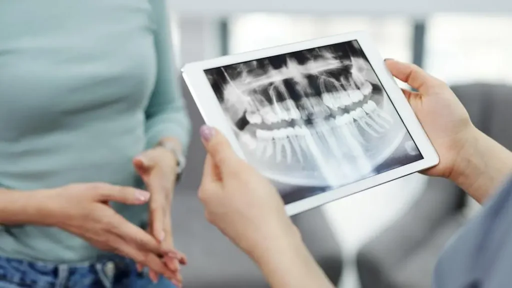 Understanding Cavities Under Dental Crowns and Fillings