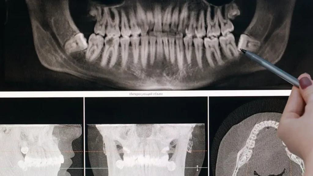 Understanding the Risks of Not Treating a Cavity
