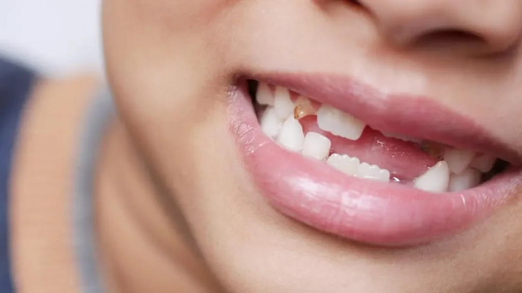 What Are Dental Bridges? Thornton Options & Costs