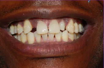 Smile before dental treatment, case 1