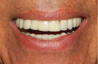 Smile after dental treatment, case 2