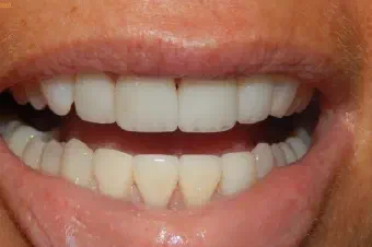 Smile after dental treatment, case 4