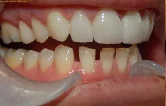 Smile before dental treatment, case 4