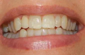 Smile after dental treatment, case 5