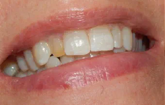 Smile before dental treatment, case 5