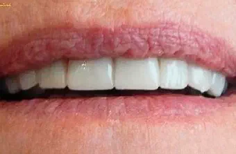 Smile after dental treatment, case 6