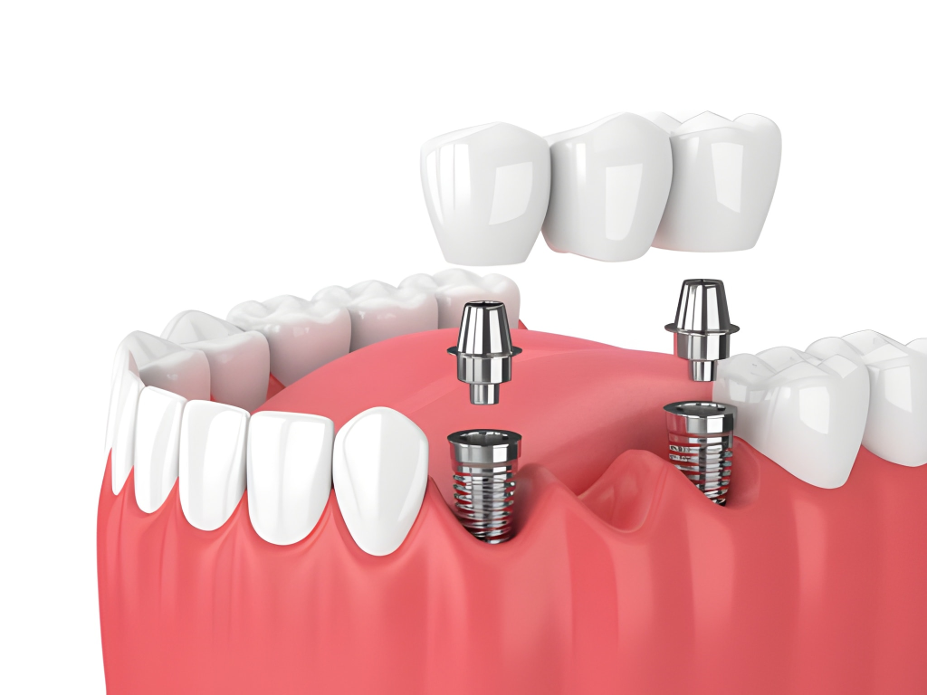dental bridges near you