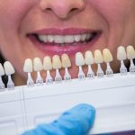 porcelain veneer shade selection for a natural and customized smile makeover