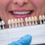 porcelain veneers for a natural smile transformation