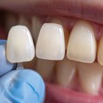 dental bonding treatment matching tooth shade for a natural smile restoration