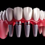 implant-supported dental bridge replacing multiple missing teeth for long-term smile restoration